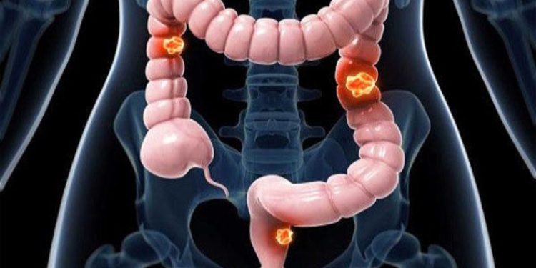 پژوهشگران مشهدی یک نانو دارو برای درمان سرطان روده ساختند
