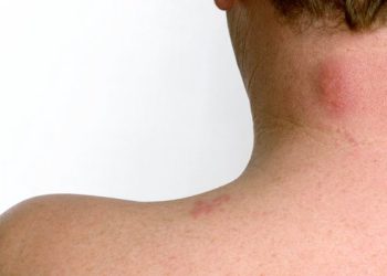 عفونت قارچی پوست چیست؟