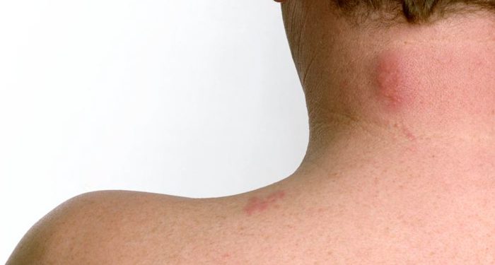 عفونت قارچی پوست چیست؟