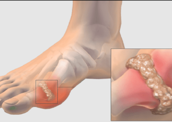 علائم، درمان و راه های پیشگیری از بیماری نقرس