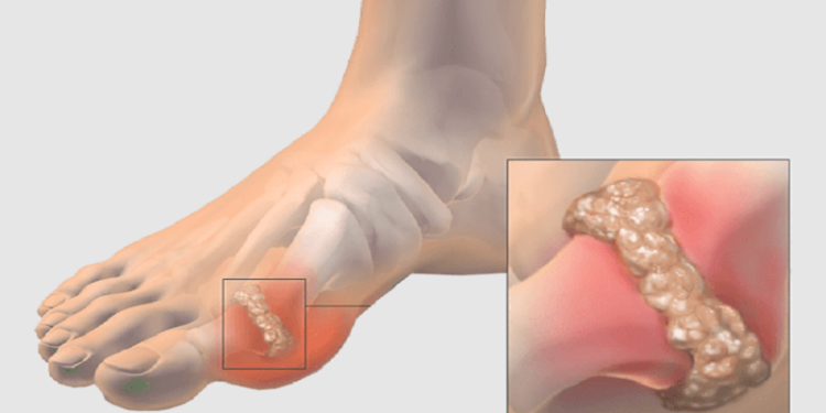 علائم، درمان و راه های پیشگیری از بیماری نقرس