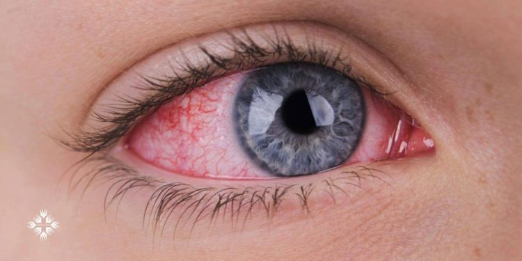 شبکیه شاخصی برای پیشبینی خطر ابتلا به سکته مغزی