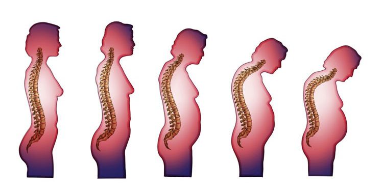 چگونه از کاهش قد در سنین بالا جلوگیری کنیم؟