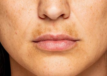 آیا می توان از لکه‌های پوستی بارداری پیشگیری کرد؟