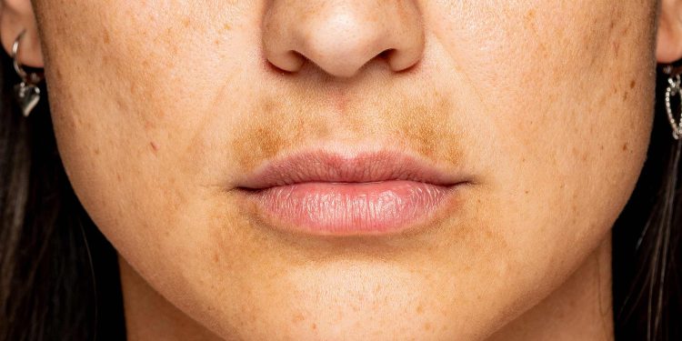 آیا می توان از لکه‌های پوستی بارداری پیشگیری کرد؟