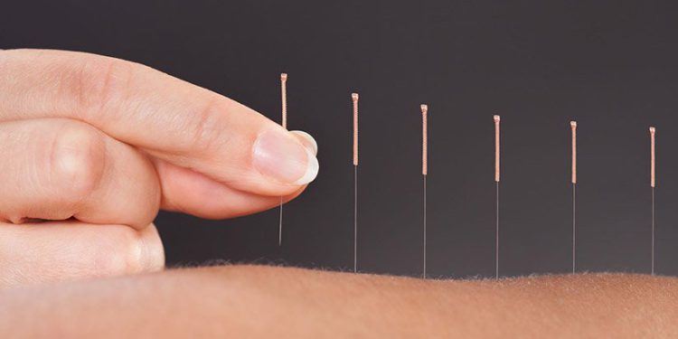 چه بیماری‌هایی به کمک طب سوزنی بهبود می یابند؟