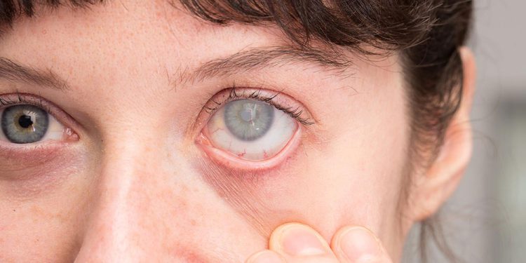 دلایل و علائم آب مروارید