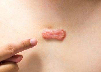 اهمیت درمان کلوئید با مشاهده اولین علائم