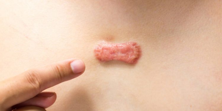 اهمیت درمان کلوئید با مشاهده اولین علائم