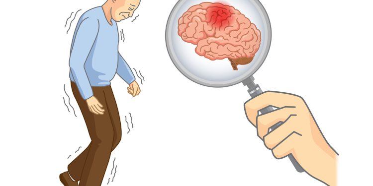 ابتلا به پارکینسون در ایران، ٤٠ درصد بیشتر از میانگین جهانی است