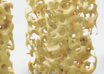 علائم و نشانه های پوکی استخوان