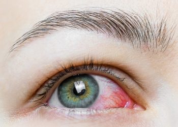 هشدار متخصص چشم در رابطه با عوارض چشمی کرونا