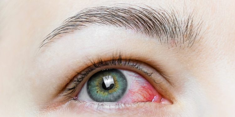 هشدار متخصص چشم در رابطه با عوارض چشمی کرونا