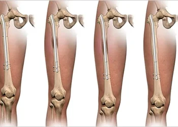 جراحی افزایش قد؛ راهکاری علمی برای درمان کوتاهی قابل‌توجه قد