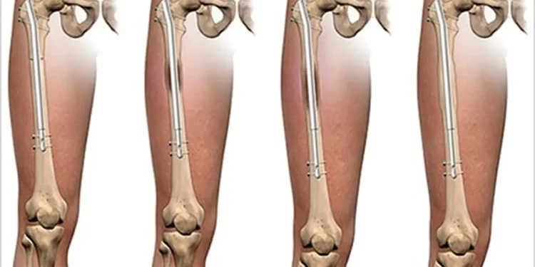 جراحی افزایش قد؛ راهکاری علمی برای درمان کوتاهی قابل‌توجه قد