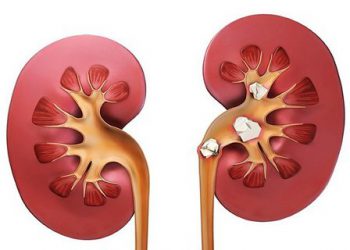 چۆن خۆمان لە دروستبوونی بەردی گورچیلە بپارێزین