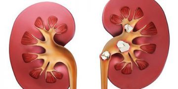 چۆن خۆمان لە دروستبوونی بەردی گورچیلە بپارێزین