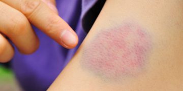 لە سەر شینبوونەوەی پێست چی دەزانین؟