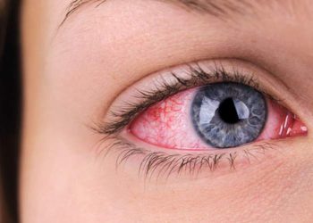 چۆن هەستیاری چاو لەم وەرزەدا چارەسەر بکەین؟