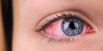 چۆن هەستیاری چاو لەم وەرزەدا چارەسەر بکەین؟