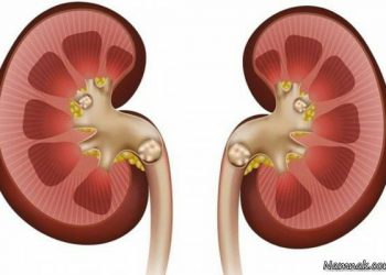 چۆن بزانین بەردی گورچیلەمان هەیە؟ چارەسەرەکەی چۆن دەبێت؟