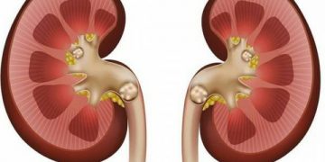 چۆن بزانین بەردی گورچیلەمان هەیە؟ چارەسەرەکەی چۆن دەبێت؟
