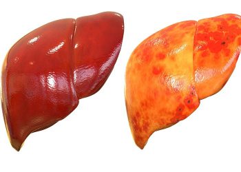 نەخۆشی چەوری جگەر لە هەرێمی کوردستان پەرە دەستێنێت