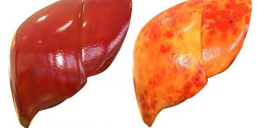 نەخۆشی چەوری جگەر لە هەرێمی کوردستان پەرە دەستێنێت