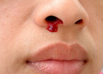 هۆکارەکانی خوێنبەربوونی لوت چییە؟