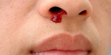 هۆکارەکانی خوێنبەربوونی لوت چییە؟