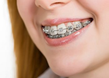 چی لە سەر تەلی ددان دەزانین؟