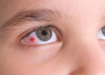 ئەگەر ئەم گۆڕانکارییانە لە چاودا بینرا دەبێت سەردانی پزیشک بکەیت