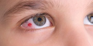 ئەگەر ئەم گۆڕانکارییانە لە چاودا بینرا دەبێت سەردانی پزیشک بکەیت