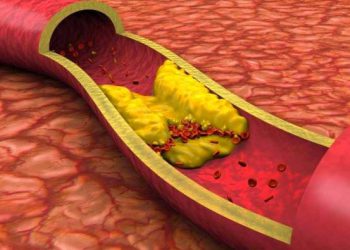 چەند ڕێگایەک بۆ چارەسەرکردنی بەرزی چەوری خوێن