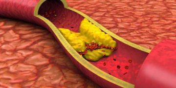 چەند ڕێگایەک بۆ چارەسەرکردنی بەرزی چەوری خوێن