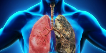 هۆکارە کاریگەرەکانی توشبوون بە شێرپەنجەی سییەکان