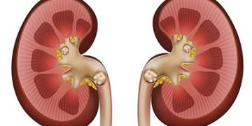 پزیشکێکی ئێرانی: بەم دە ڕێگایە چارەسەری بەردی گورچیلە دەکرێت
