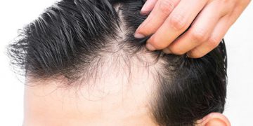 دوو یان سێ مانگ پاش توشبوون بە کۆرۆنا قژهەڵوەرین دەست پێدەکات