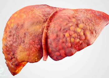 چەندین خواردنی کاریگەر لە چارەسەرکردنی چەوری جگەر