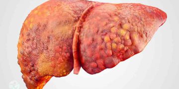 چەندین خواردنی کاریگەر لە چارەسەرکردنی چەوری جگەر