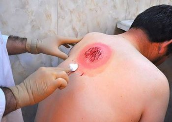 کەڵەشاخ دەتوانێت کاریگەریی لە سەر لابردنی ڤاکسێنی کۆرۆنا لە جەستەدا هەبێت؟