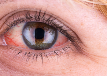 چۆن سووری چاو لە ماڵەوە چارەسەر بکەین؟