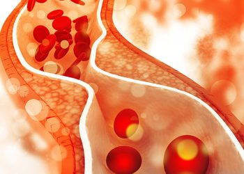 پزیشکێکی پسپۆڕ باس لە چەند ڕاستییەک لە سەر چەوری خوێن و چارەسەرکردنی دەکات