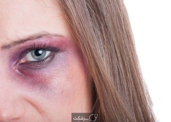 بۆ ژێری چاو ڕەش دەبێتەوە؟