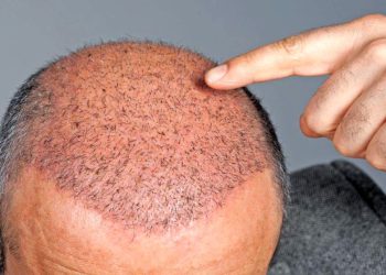 زانیاری تەواو لە سەر چاندنەوەی قژی پیاوان