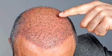 زانیاری تەواو لە سەر چاندنەوەی قژی پیاوان