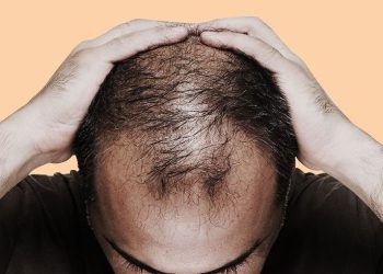 چەند خۆراکێک کە دەبنە هۆکاری ڕوتانەوەی قژی پیاوان