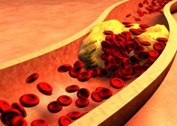 مەترسییەکانی بەرزبوونەوەی چەوری خوێن