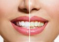 چۆن زەردبوونی ددانەکان چارەسەر بکەین؟