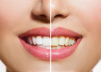 چۆن زەردبوونی ددانەکان چارەسەر بکەین؟